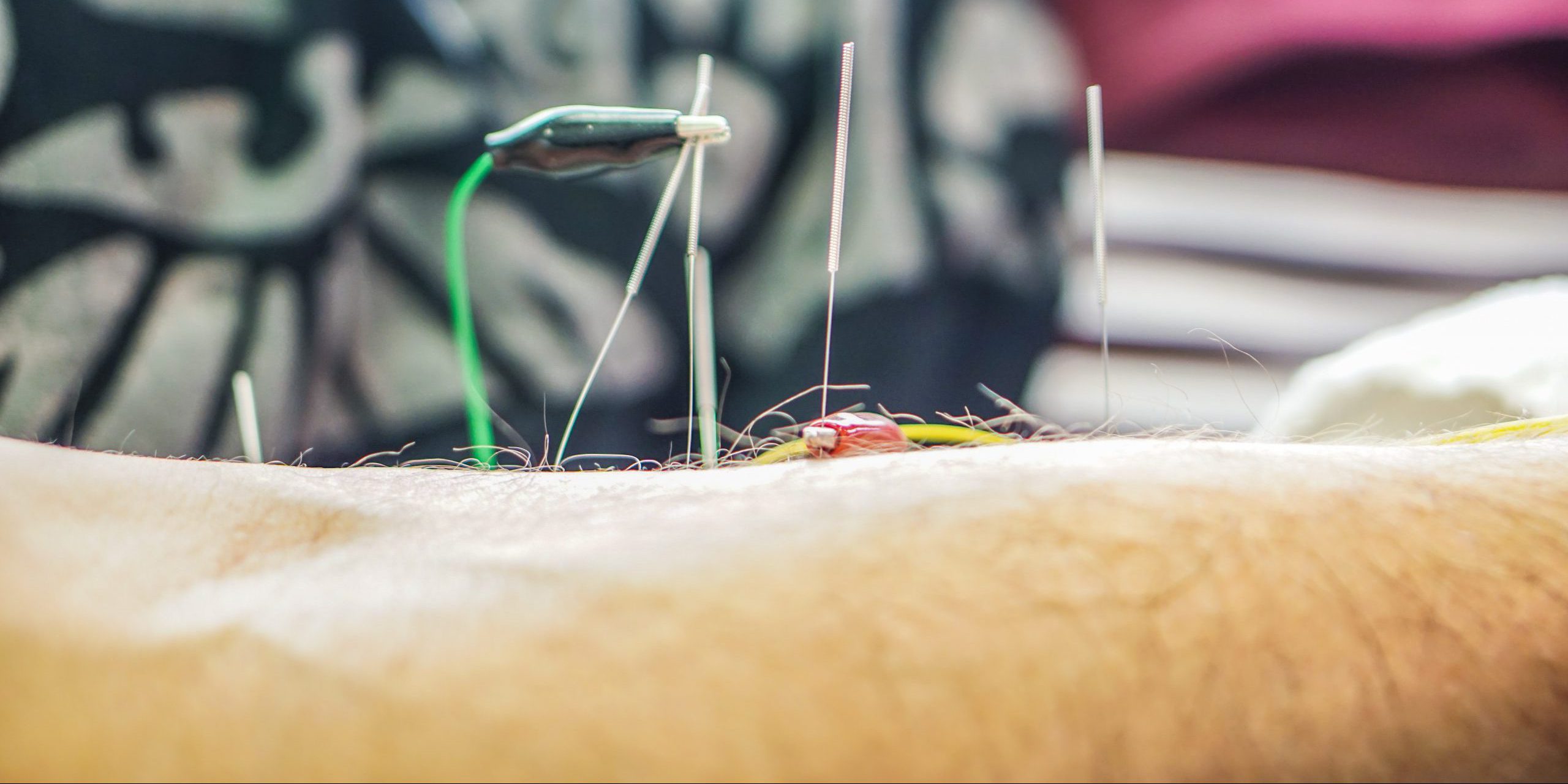 Athletes and the Benefits of Acupuncture