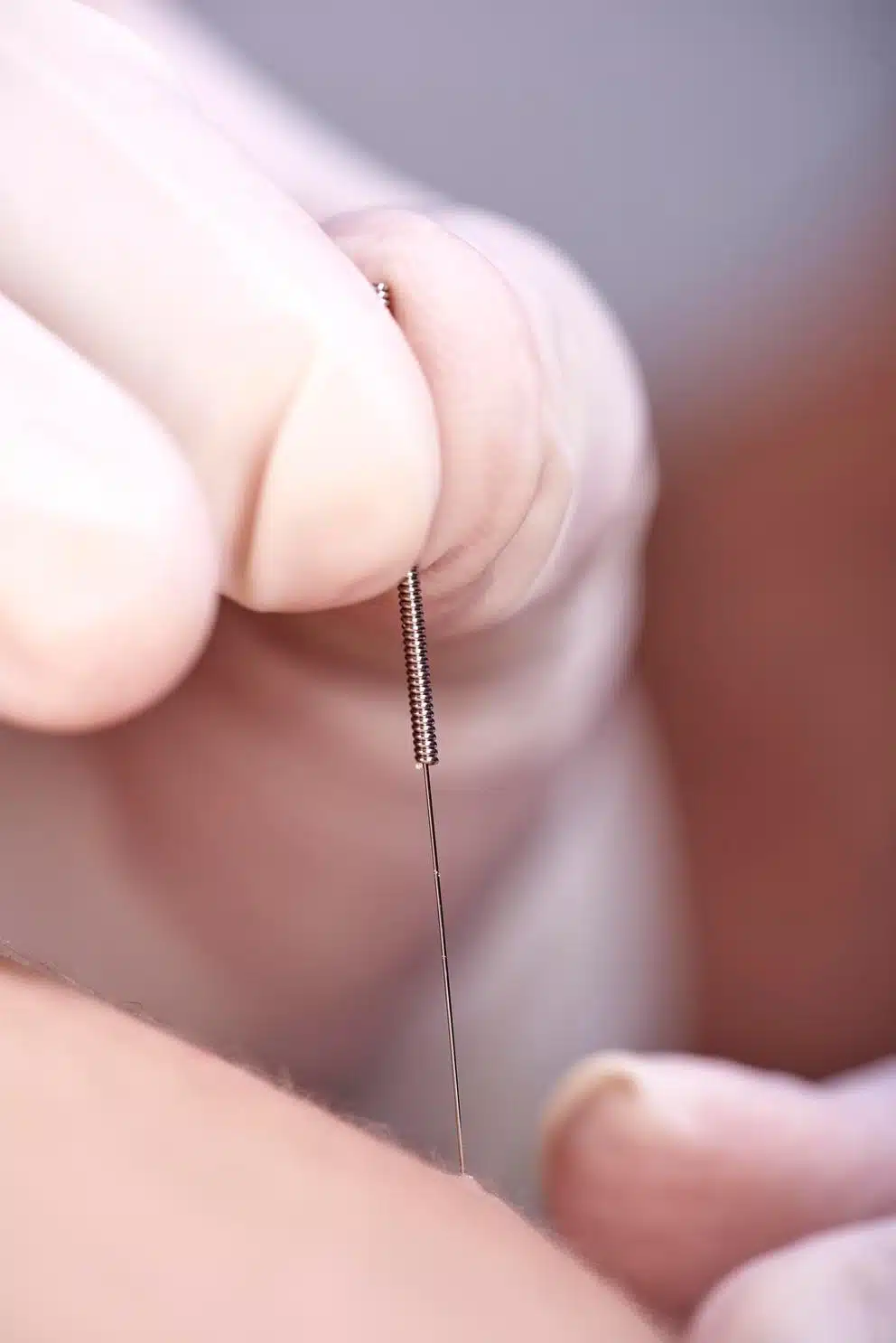 Cropped hands of person doing acupuncture